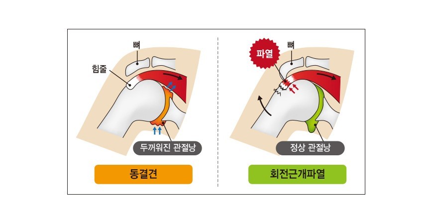 오십견, 어깨통증완화에 좋은 영양제