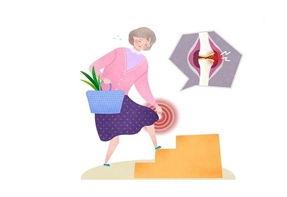골다공증 환자 100만 시대 골다공증 예방하는 방법