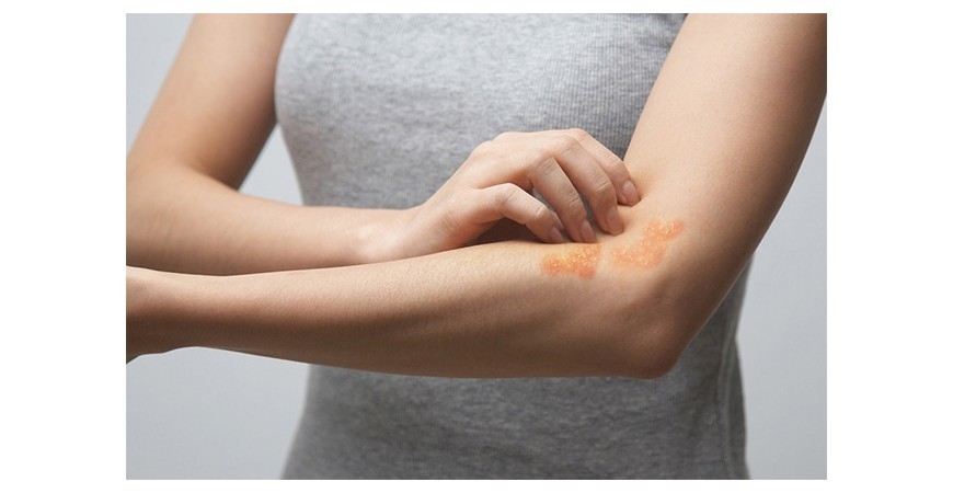 건선(Psoriasis)을 완화하는 자연요법