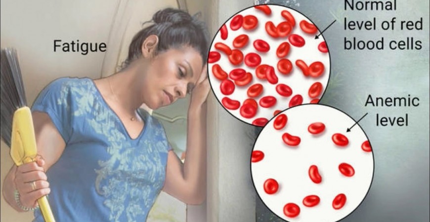 철분 결핍을 알리는 신호와 빈혈에 도움이 되는 영양제 비타민