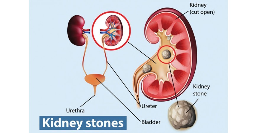 요로결석(Urinary stone) 원인과 예방에 좋은 영양제