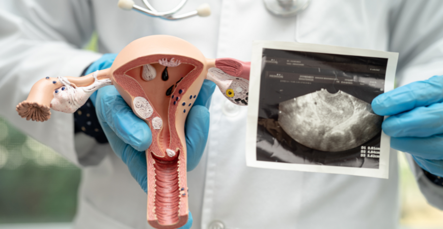 이노시톨 (Inositol), 다낭성난소증후군(PCOS)의 증상 개선과 기타 효능