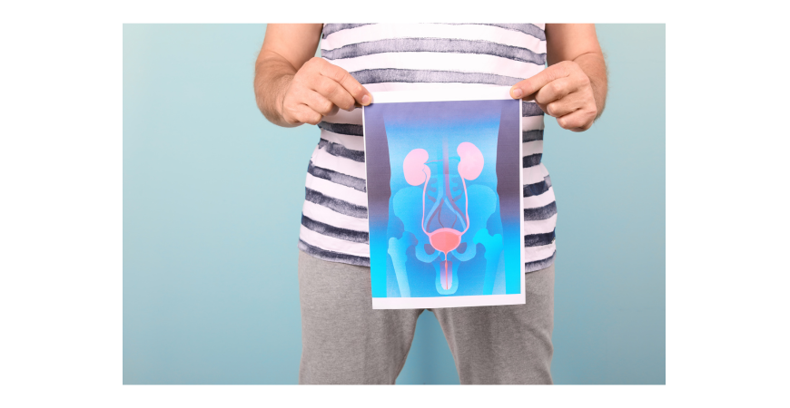 쏘팔메토(Saw palmetto), 전립선건강에 효과 있을까?