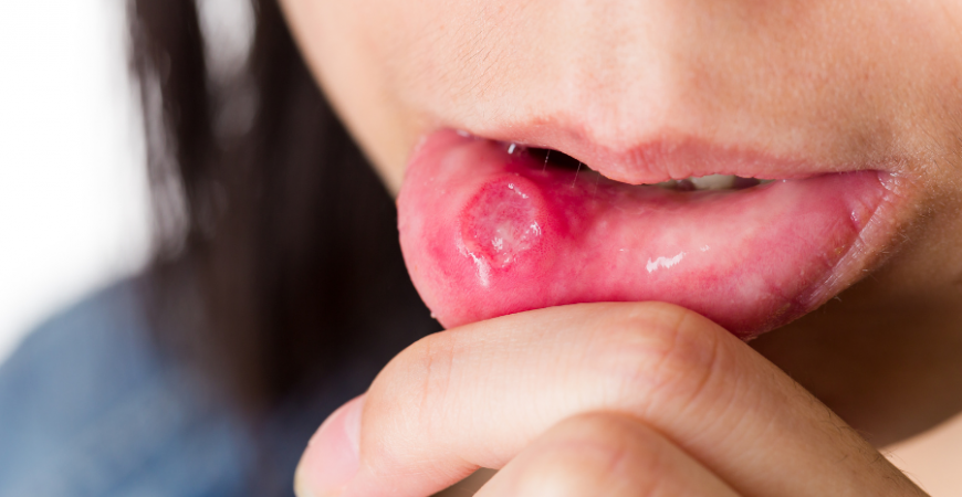 구내염, 혓바늘 빠르고 쉽게 낫는 방법