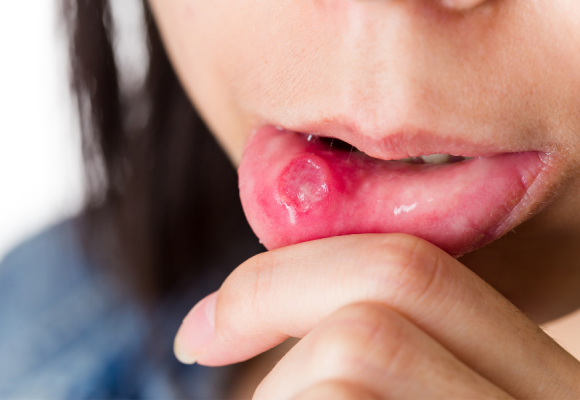 구내염, 혓바늘 빠르고 쉽게 낫는 방법