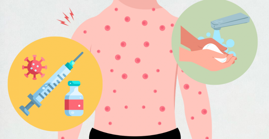 홍역 유행 비상! 증상과 예방방법은?