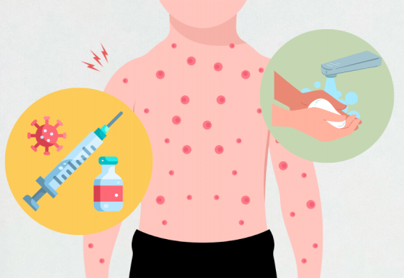 홍역 유행 비상! 증상과 예방방법은?