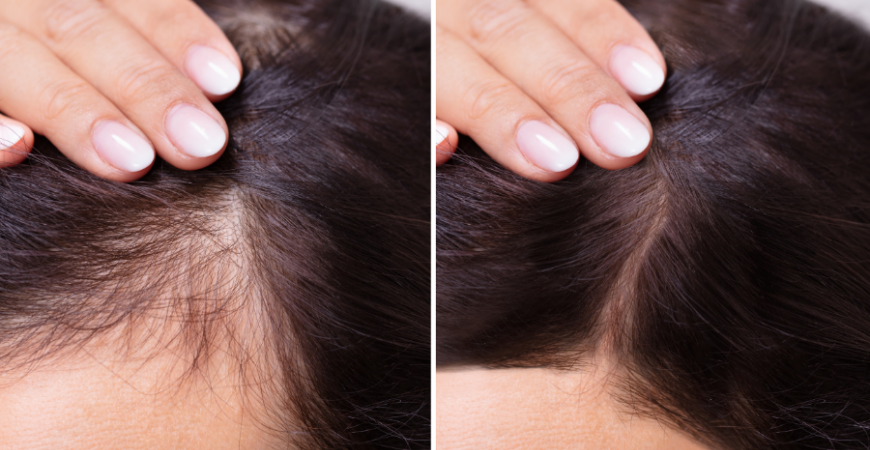 남성 탈모에 가장 효과적인 영양제 조합