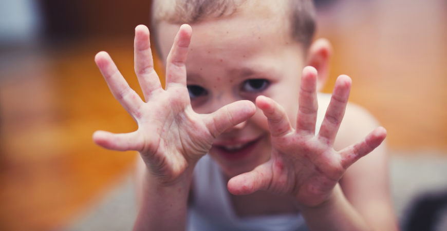 수족구병 예방: 아이를 보호하는 가장 효과적인 방법
