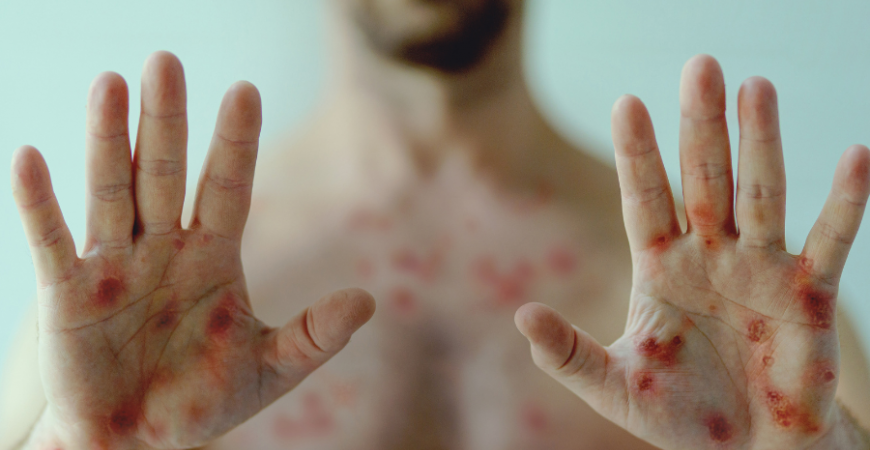 이 증상이 있다면 원숭이 두창을 의심해 봐야한다?