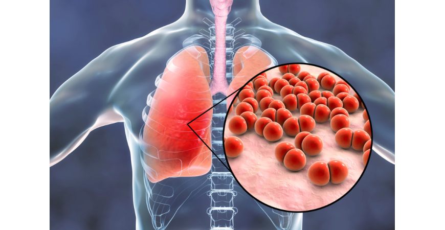 감기로 오인하기 쉬운 보행성 폐렴, 꼭 알아야 할 체크리스트