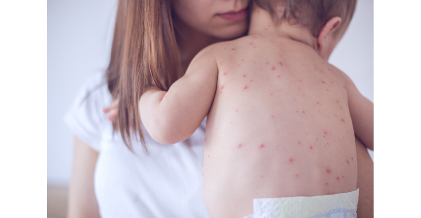 다시 유행하는 홍역, 당신도 안전할까?