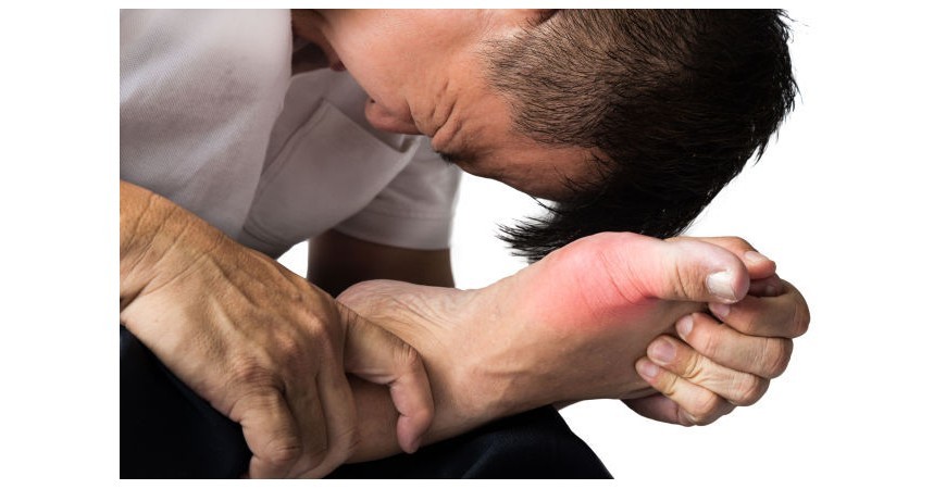 질병의 왕 고요산혈증, 통풍 완화 예방 영양제