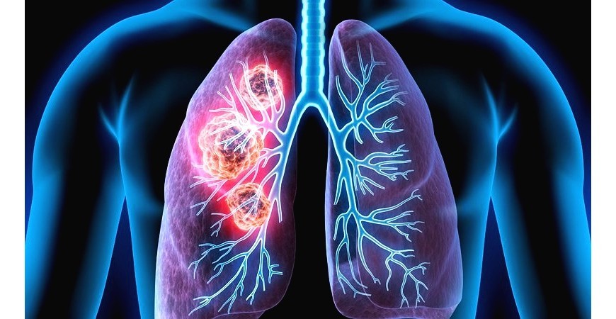 호흡기 폐 건강지키는 생활습관과 영양성분